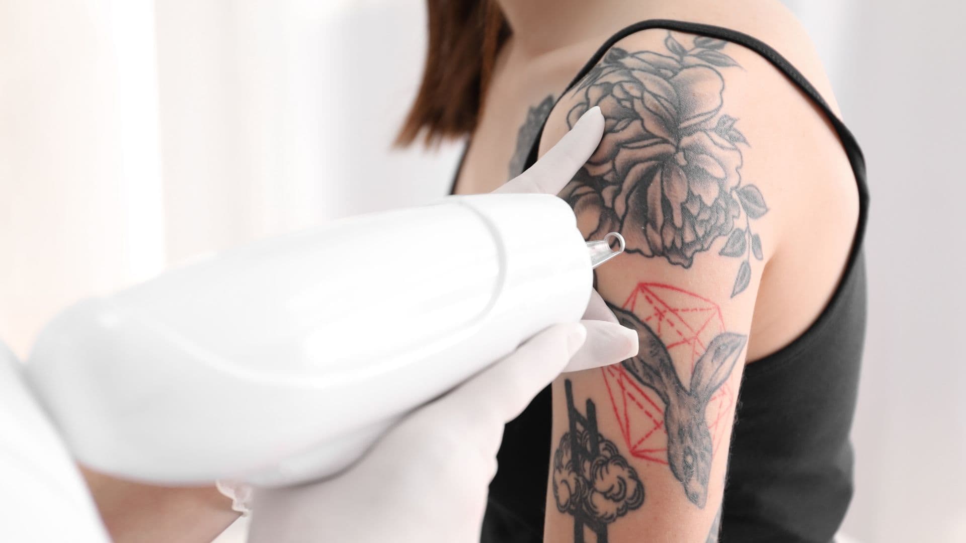 Laser Tattoo Removal